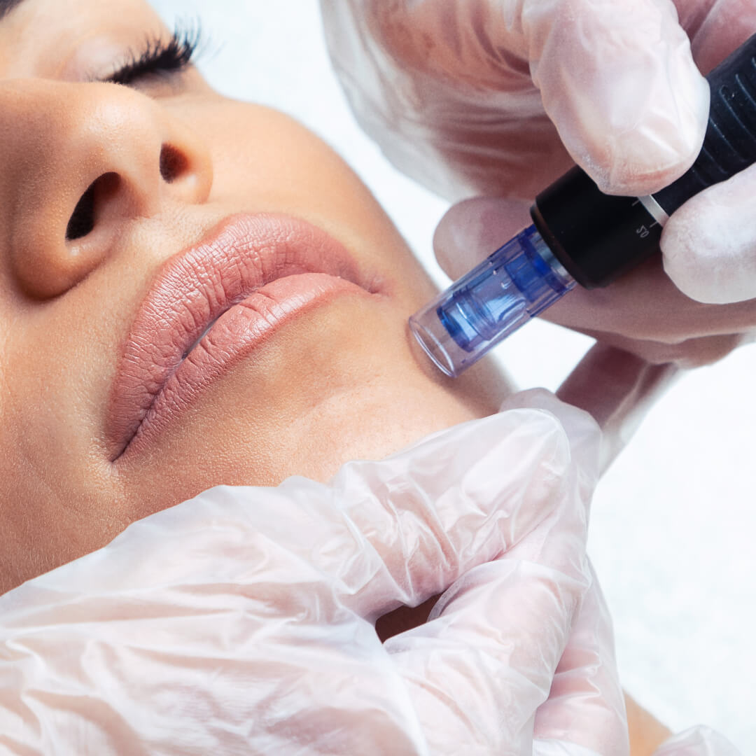 Woman making a microneedling procedure