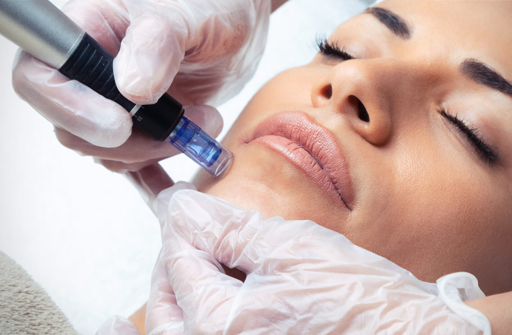 Professional beautician performing a meticulous microneedling treatment on a relaxed client's face in a clinic.