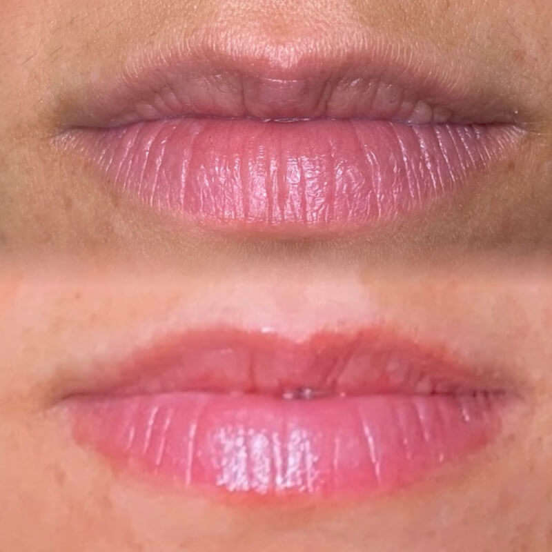 Microneedling Procedure before and after