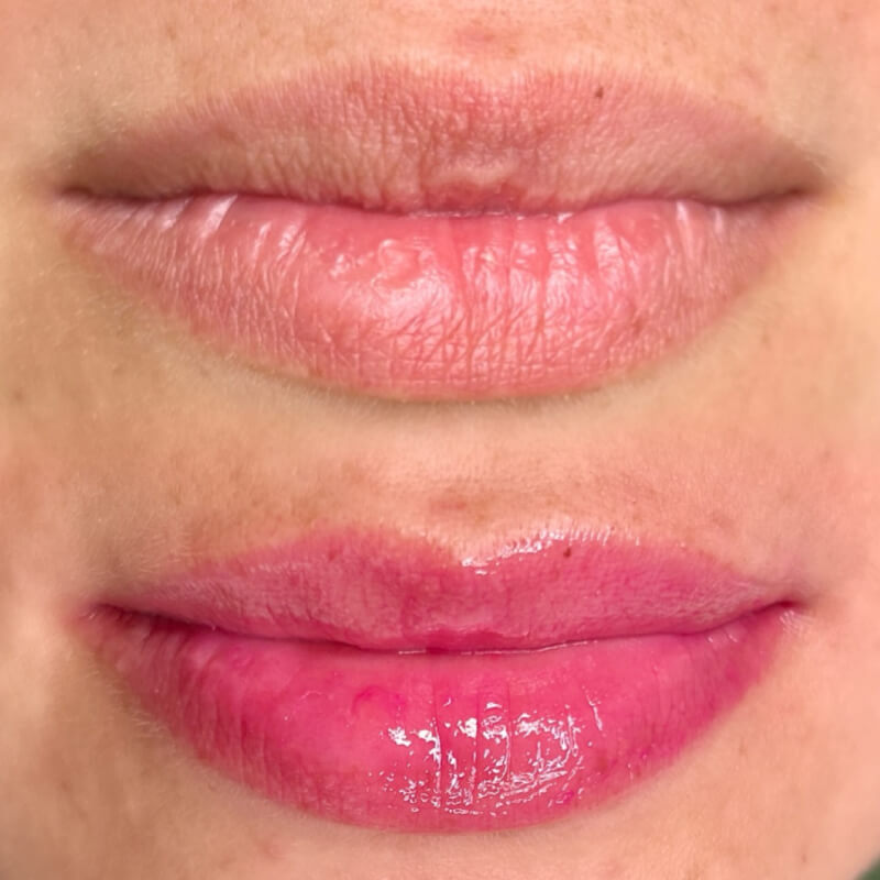 Microneedling Procedure before and after