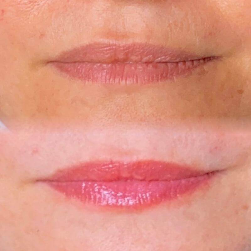 Microneedling Procedure before and after